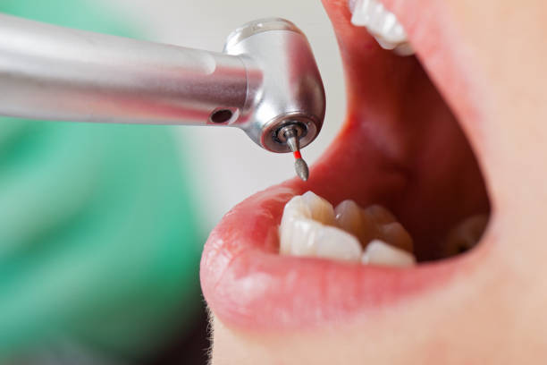 Best Dental Abscess Treatment in Pittsboro, NC